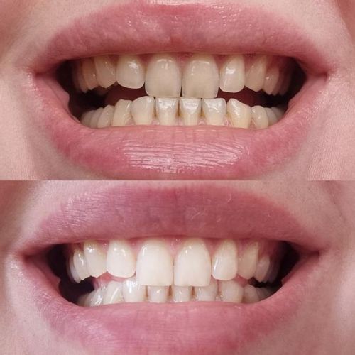 Stylo de blanchiment des dents PAP SMILE NOW